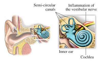 Intratympanic steroid injection sudden hearing loss